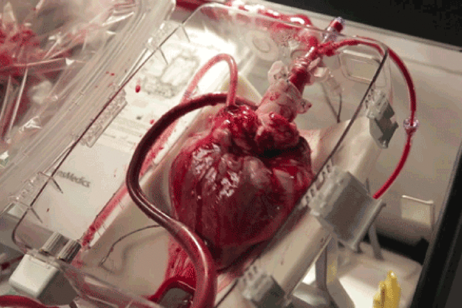 Heart_transplant_boxx519.0.0.gif