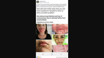 Fact Check: NO Evidence That Face Masks Cause Staph Infections