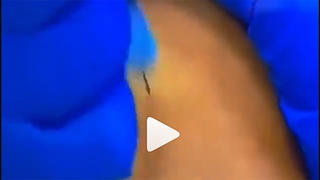 Fact Check: There Is NOT Anything Fake About This Type Of 'Needle'