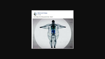 Fact Check: This Is NOT An X-Ray Of A 700-Pound Man -- It's A Digital Artist's Rendering