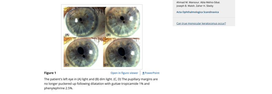 two pupils in one eye