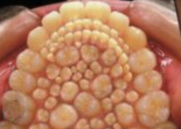 Fact Check: NO Evidence 'Hyperdontia' Photo Is Real