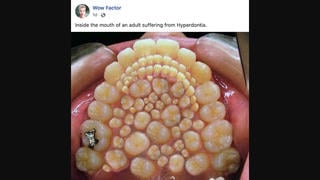 Fact Check: NO Evidence 'Hyperdontia' Photo Is Real