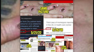 Fact Check: Old Stock Photos Of Monkeypox Lesions Do NOT Mean Fraud By Press