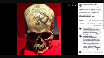 Fact Check: NO Evidence This Skull Is Example Of Early Cranioplasty