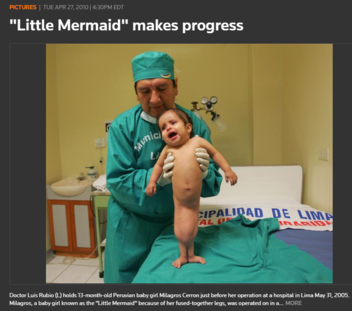Fact Check: Image Of Baby With Fish Tail Is NOT Real -- It's Manipulated Version Of A Real Image