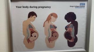 Fact Check: NHS King's College Hospital Does NOT Produce Or Post An Informational Poster That Shows Pregnant Men 