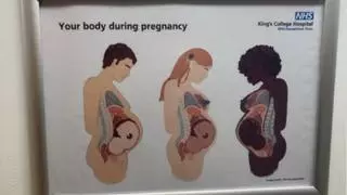 Fact Check: 'Your Body During Pregnancy' Graphic Did NOT Appear In Official King's College Hospital NHS Poster 